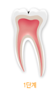 충치레진 vs 인레이&middot;크라운 차이, 언제 결정될까요? 관련 이미지 5