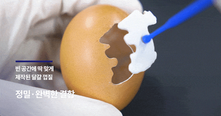 덧니 라미네이트 VS 덧니치아교정, 이 글로 고민 끝내드립니다 관련 이미지 15