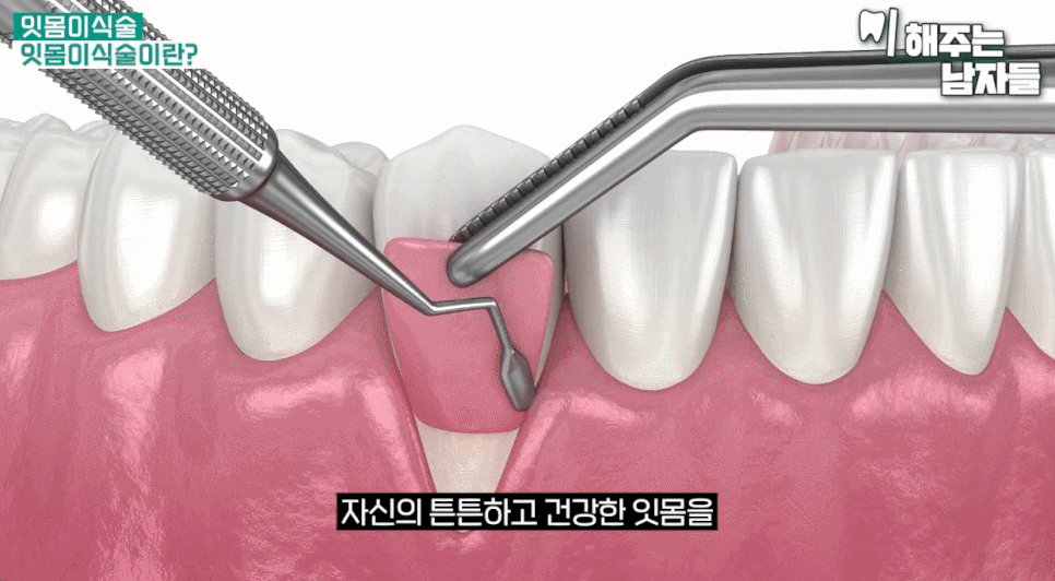 잇몸이식수술로 내려앉은 잇몸 다시 건강하게 채우는 법 관련 이미지 5