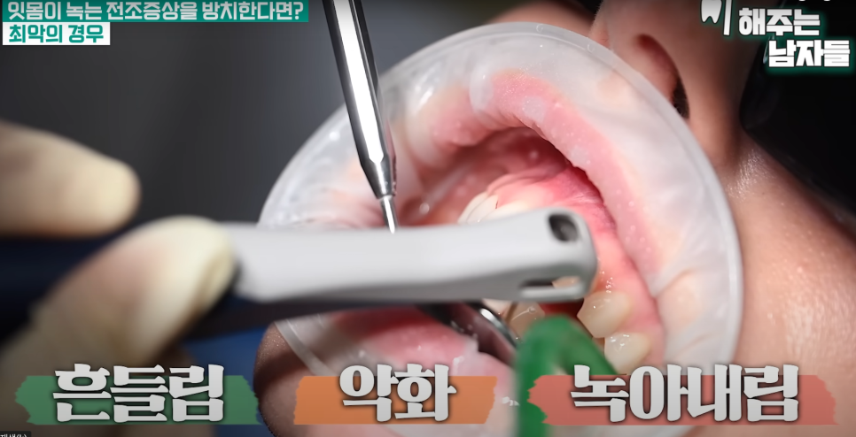 서울역스케일링 잇몸이 보내는 위험 신호, 절대 놓치지 마세요 관련 이미지 6