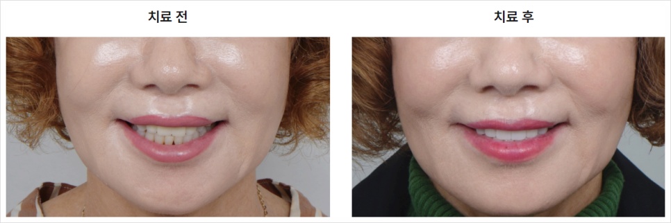 Read This If Veneers at MINISH Dental Clinic Feel Like Too Much image 11