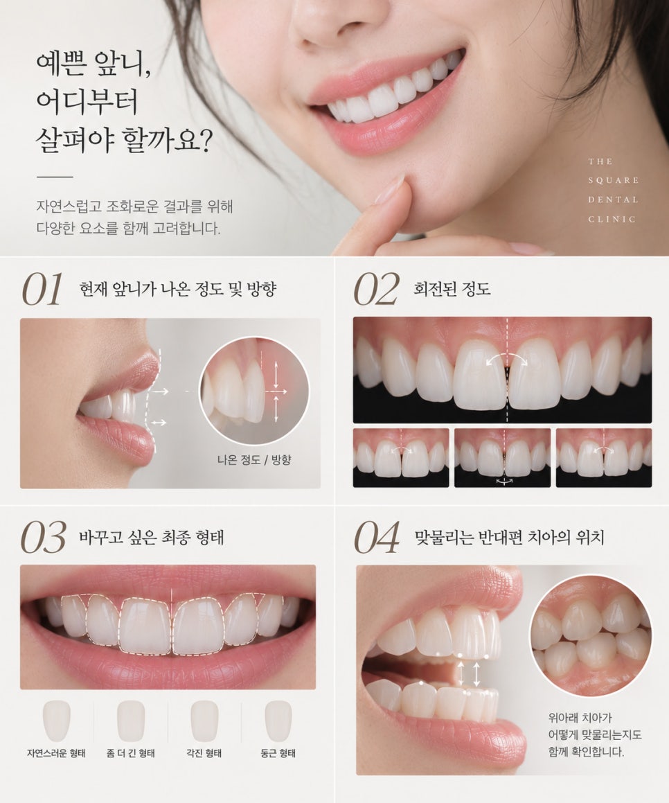 라미네이트치아삭제와 치아 라미네이트 비용은 비례할까? 관련 이미지 7