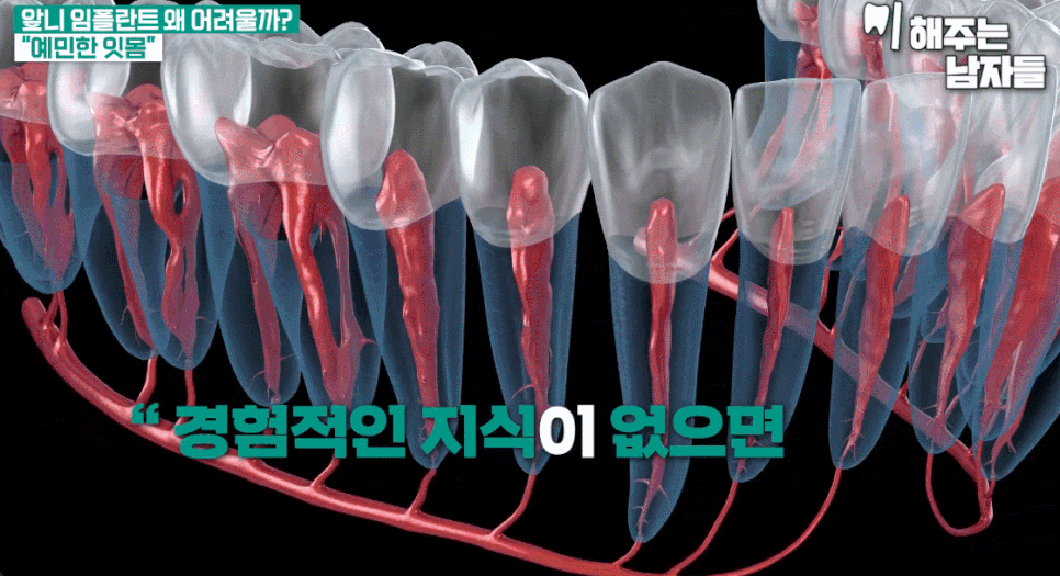 임플란트발치 즉시 식립 VS 지연 식립 나에게 맞는 타이밍은 관련 이미지 9