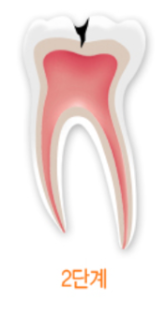 충치레진 vs 인레이&middot;크라운 차이, 언제 결정될까요? 관련 이미지 6
