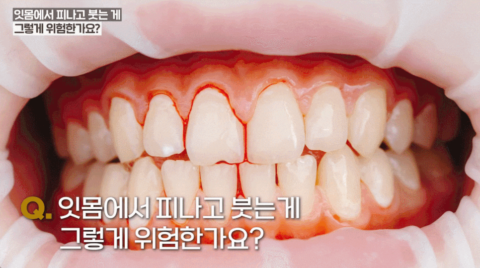 My Gums Hurt: A Complete Guide to Gum Bleeding While Brushing, Home Care, and Dental Gum Treatment image 2