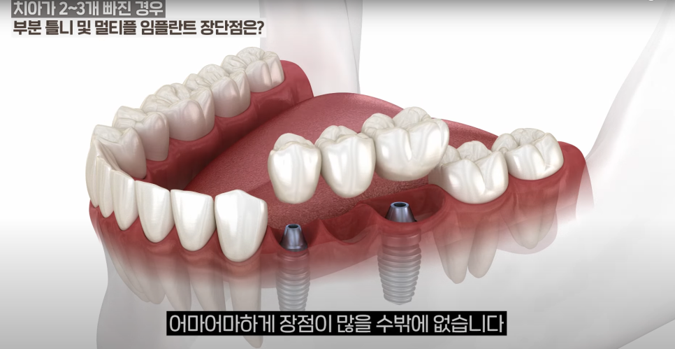 소곡동임플란트 치아가 몇 개만 빠졌을 때, 어떤 치료를 받아야할까? 관련 이미지 5