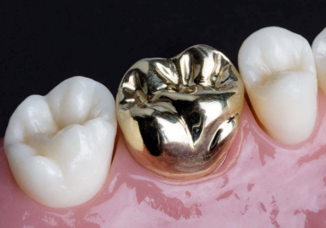 Crowns After Root Canal Treatment <When Root Canal Treatment Is Needed & Features of Each Crown Material> image 13