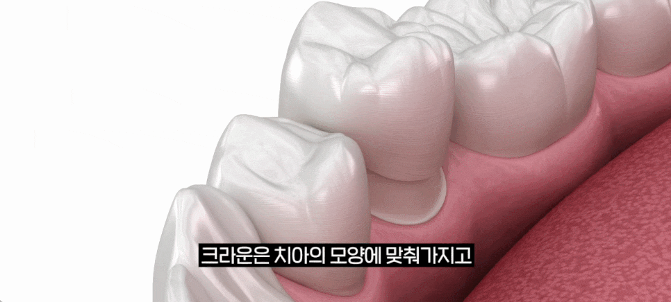 오버레이치과 크라운 단점을 보완한 <오버레이의 모든 것> 관련 이미지 5