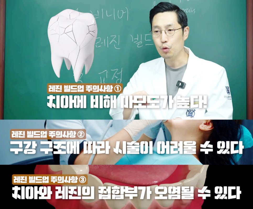 앞니 블랙트라이앵글 치료 : 레진 VS 비니어큐브 VS 교정 가이드 관련 이미지 8