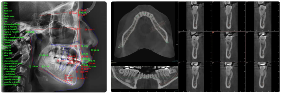 벌어진치아교정, 같은 틈이라도 원인에 따라 나뉩니다. 관련 이미지 5