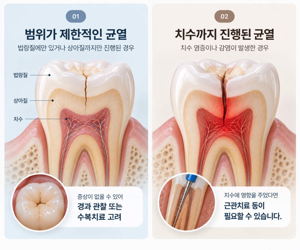 이가시린이유, 어금니 금갔을때 나타날 수 있는 증상은? 관련 이미지 8