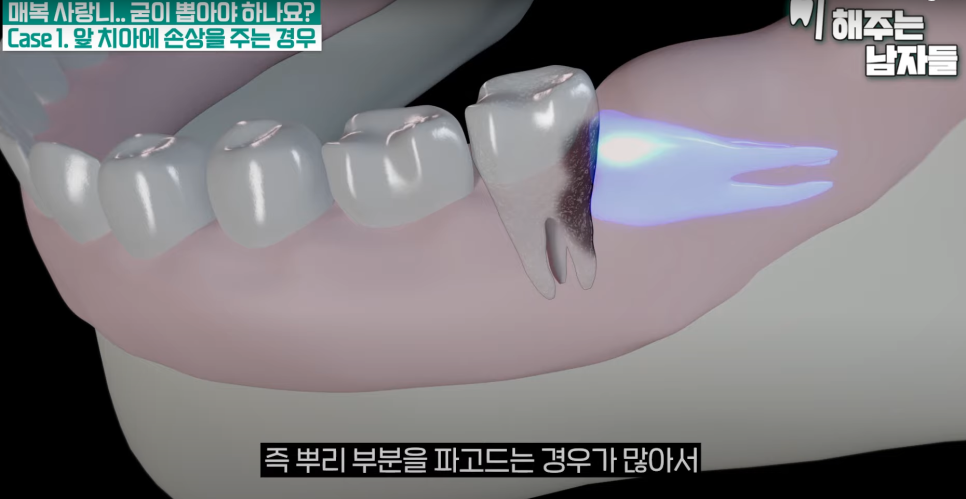 경복궁역사랑니, 안 보이는 사랑니도 발치가 필요한가요? 관련 이미지 4