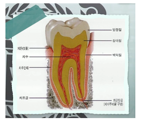 충치레진 vs 인레이&middot;크라운 차이, 언제 결정될까요? 관련 이미지 2