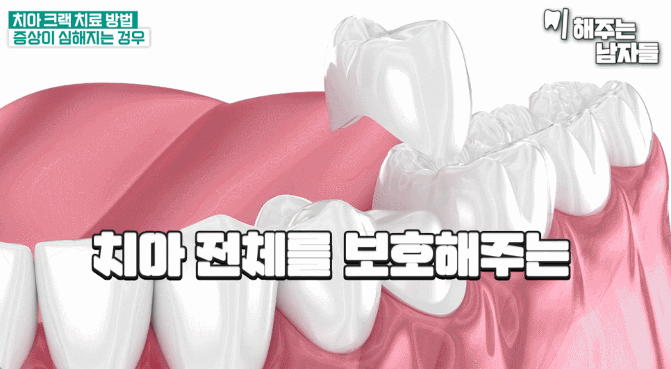 치아 크랙 치료 여부 및 증상별 치료법까지 3분 정리 관련 이미지 12