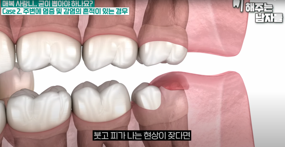 경복궁역사랑니, 안 보이는 사랑니도 발치가 필요한가요? 관련 이미지 5