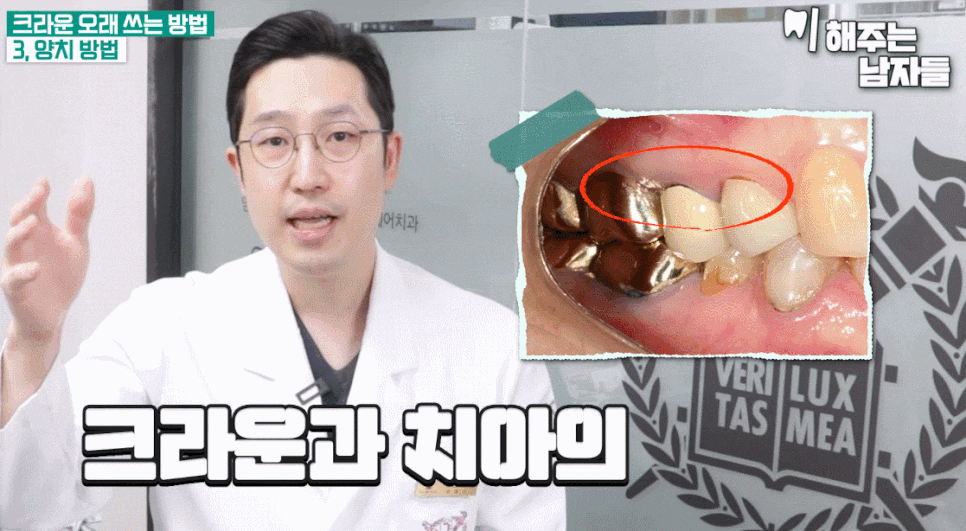 크라운신경치료 여부 & 크라운 치료 기간 & 수명 요점 정리 관련 이미지 15