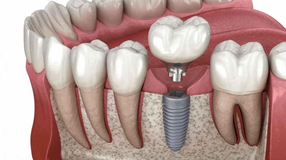 임플란트저렴한곳? 저렴함 뒤에 숨겨진 차이를 보셔야 합니다. 관련 이미지 2