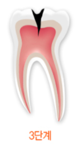 충치레진 vs 인레이&middot;크라운 차이, 언제 결정될까요? 관련 이미지 7