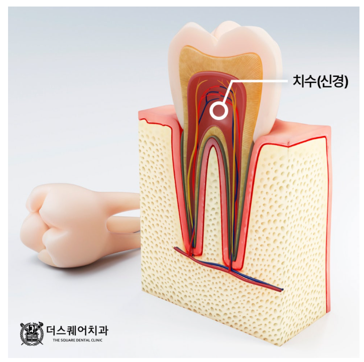 신경치료 후 치아 색 차이, 실활치미백으로 접근하는 이유 관련 이미지 2