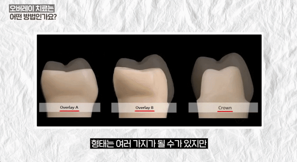 오버레이치과 크라운 단점을 보완한 <오버레이의 모든 것> 관련 이미지 10