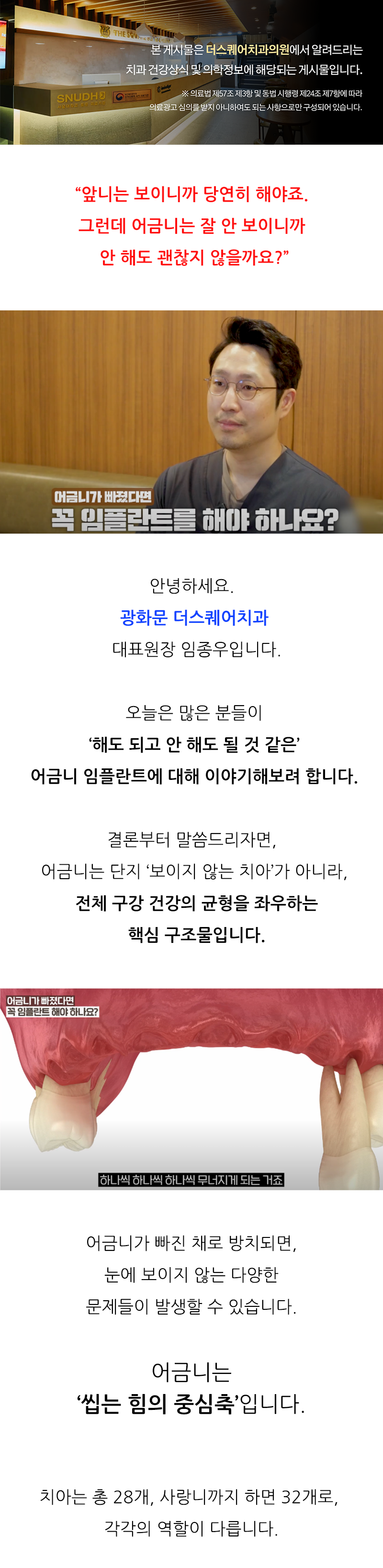 종각치과 어금니빠짐 안정적인 관리를 위해 관련 이미지 1