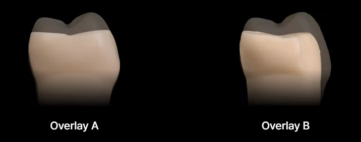 어금니 보철 전, 오버레이크라운 먼저 확인해 보세요. 관련 이미지 4