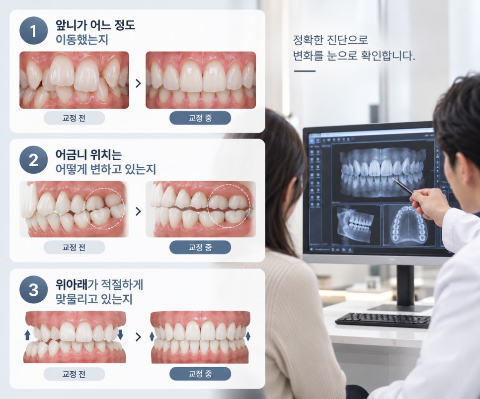 치아교정발치 왜 필요할까요? 서울치아교정에서 살펴볼 기준 관련 이미지 8