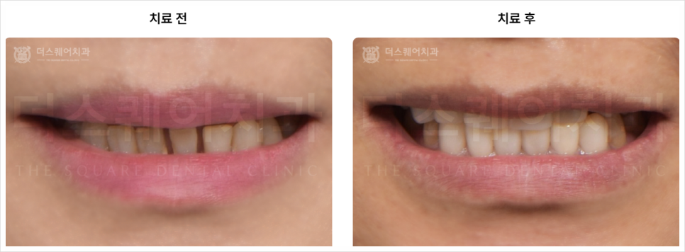 미니쉬비용 아깝지 않을 치과 선택법 알려드리겠습니다 관련 이미지 11