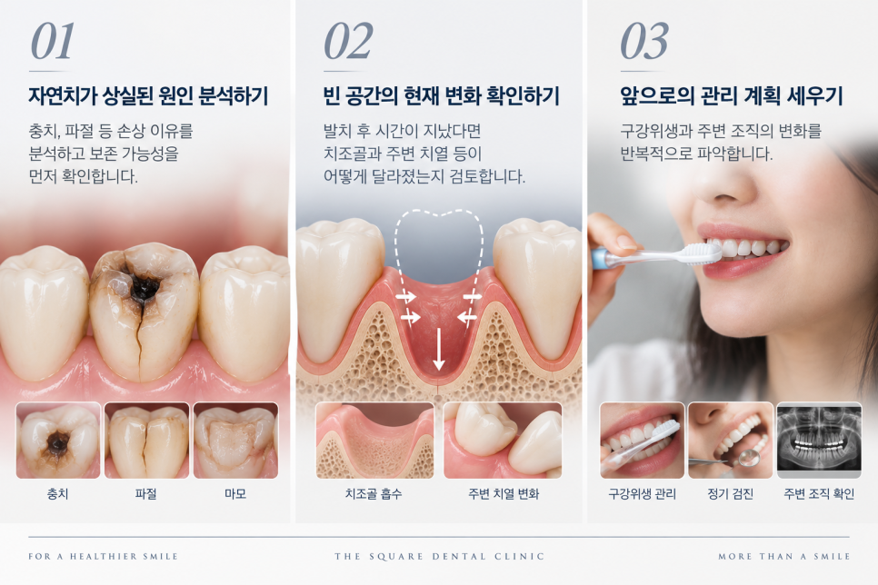 30대 임플란트, 나이보다 중요한 것은? 광화문 치과 상담 가이드 관련 이미지 12