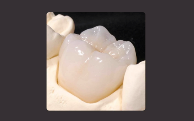 Crowns After Root Canal Treatment <When Root Canal Treatment Is Needed & Features of Each Crown Material> image 16