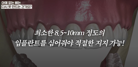 광화문 임플란트 할 때, 뼈이식이 필요한 이유 관련 이미지 6