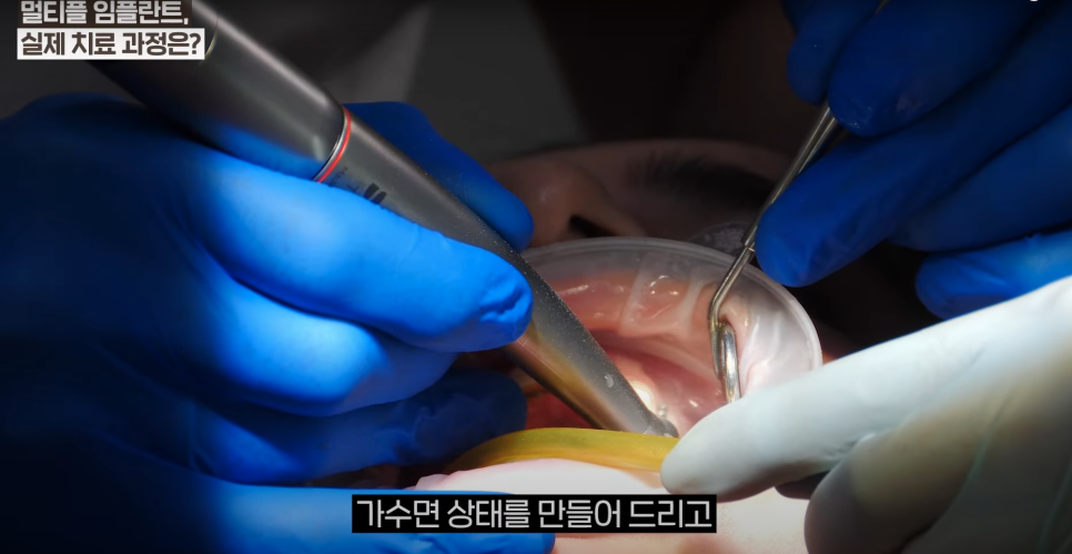 소곡동임플란트 치아가 몇 개만 빠졌을 때, 어떤 치료를 받아야할까? 관련 이미지 7