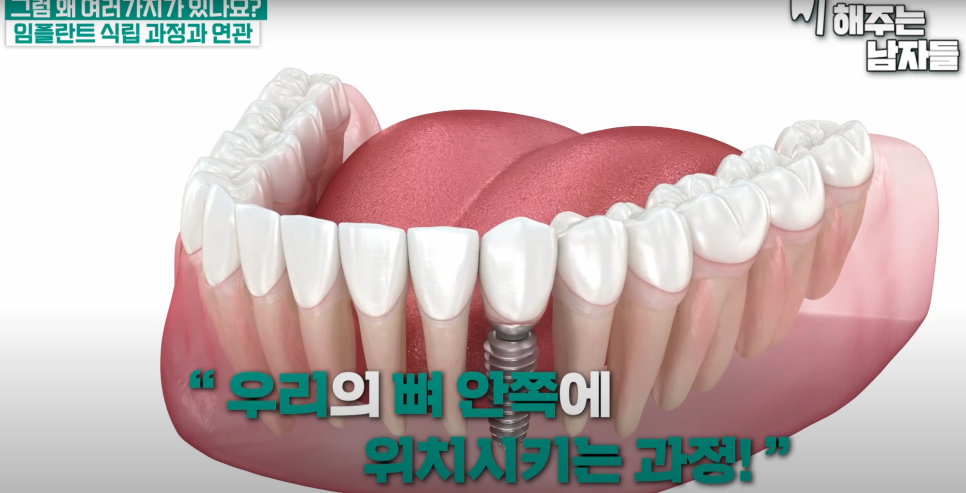 충무로임플란트, 뿌리처럼 단단히 자리 잡게 하는 비밀은? 관련 이미지 1