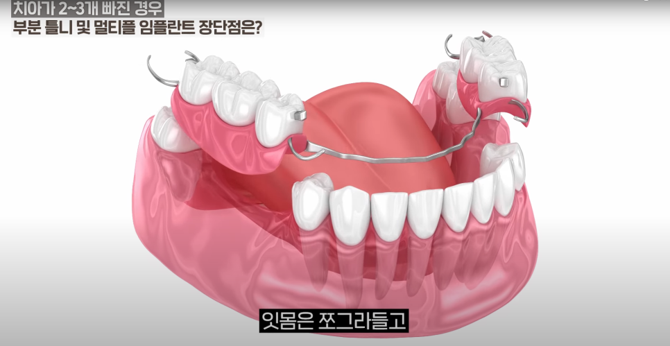 소곡동임플란트 치아가 몇 개만 빠졌을 때, 어떤 치료를 받아야할까? 관련 이미지 3