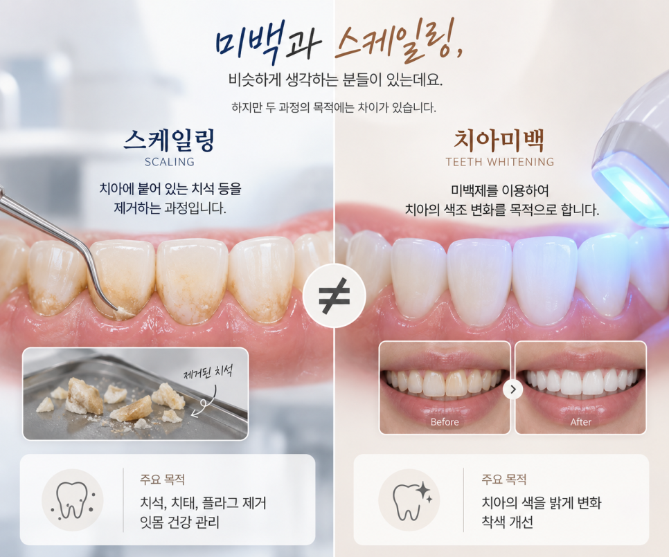 치과 치아미백 바로 밝아질까? 광화문 치과에서 확인할 3가지 관련 이미지 5