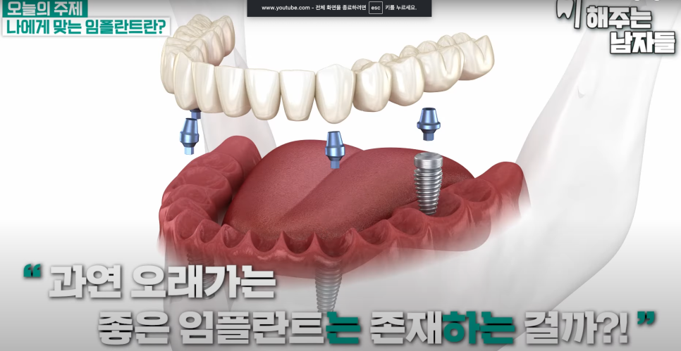 용산임플란트, 브랜드보다 중요한 것은 따로 있습니다 관련 이미지 1