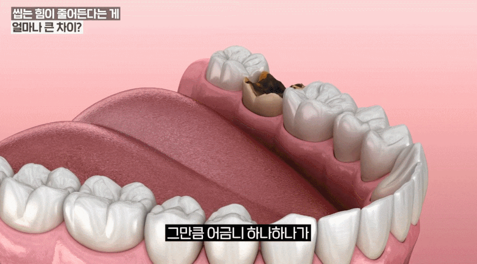 보험임플란트, 65세 넘으면 바로 해도 될까요? 관련 이미지 2