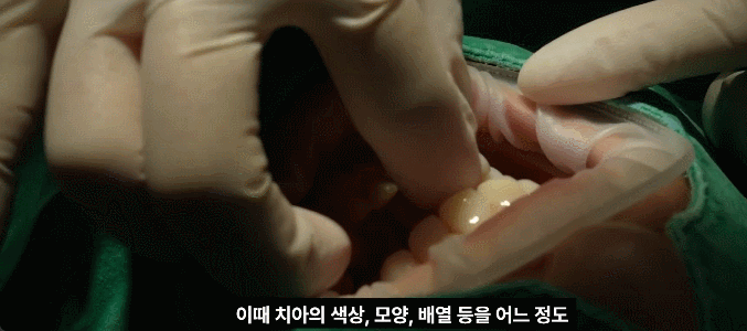 왜소치 교정, 작은 치아 무작정 키우기 전 알아야 할 팩트 관련 이미지 10
