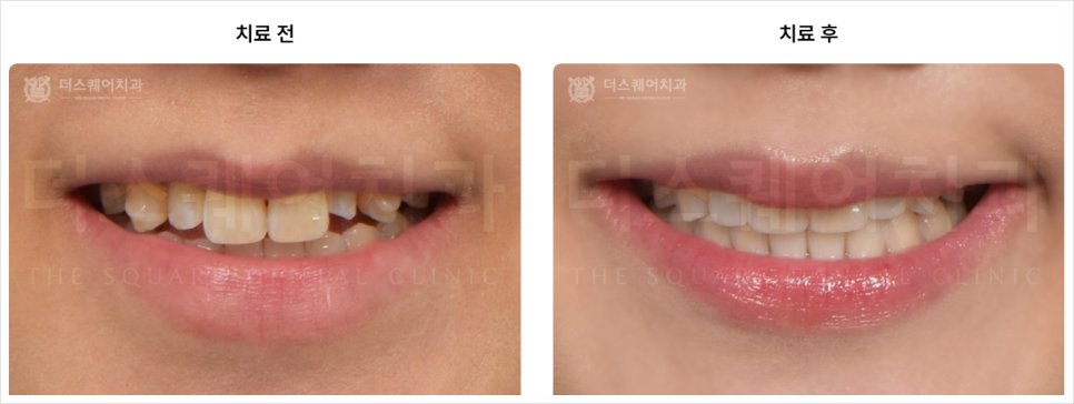 미니쉬비용 아깝지 않을 치과 선택법 알려드리겠습니다 관련 이미지 9