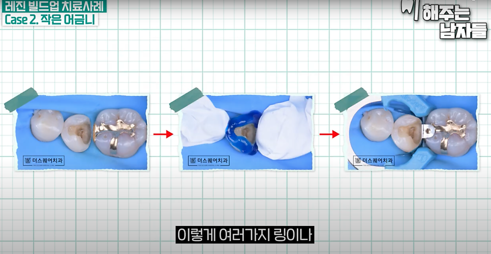 마포충치치료 당일에 끝나는 충치치료, 레진 빌드업이란? 관련 이미지 6
