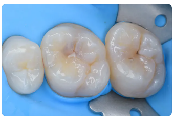 어금니충치깨짐? 레진빌드업치과에서 남아 있는 조건을 먼저 보는 이유 관련 이미지 7