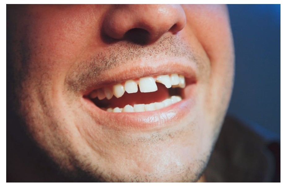 앞니 깨졌을때, 레진으로 끝날지 크라운으로 갈지 여기서 갈립니다. 관련 이미지 2