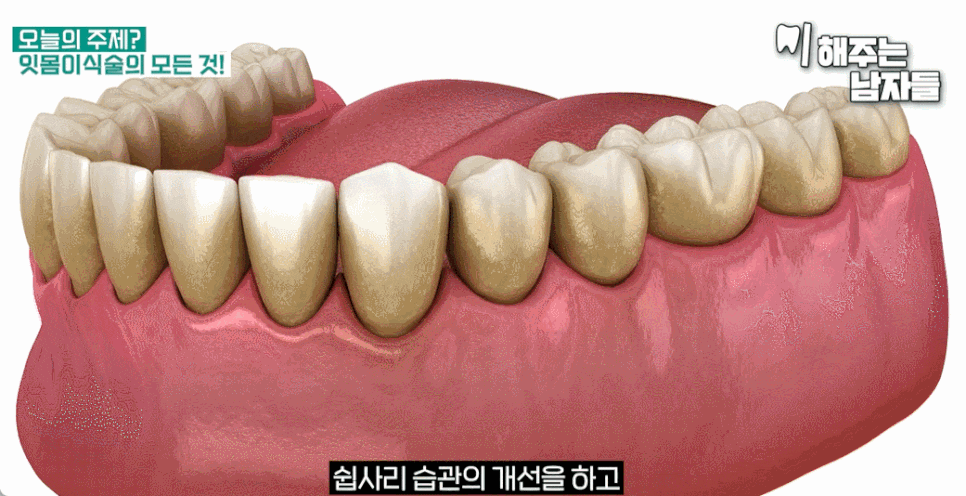 "잇몸이아파요" 피가 안 나는데 왜 욱신거릴까요? 관련 이미지 3