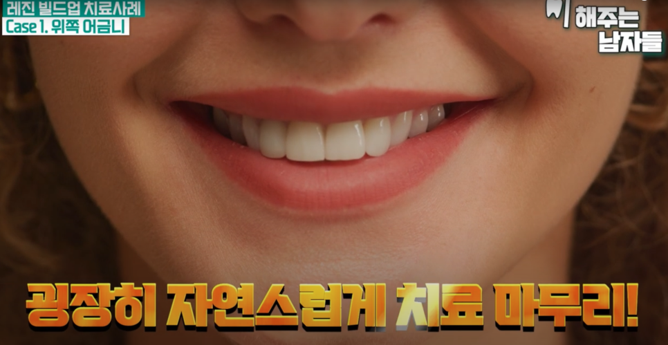 마포충치치료 당일에 끝나는 충치치료, 레진 빌드업이란? 관련 이미지 7