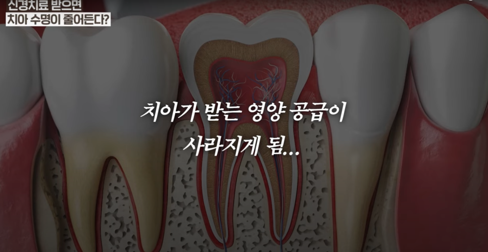 동대문구신경치료 치아를 살리는 또 하나의 선택, 치수절단술 관련 이미지 3