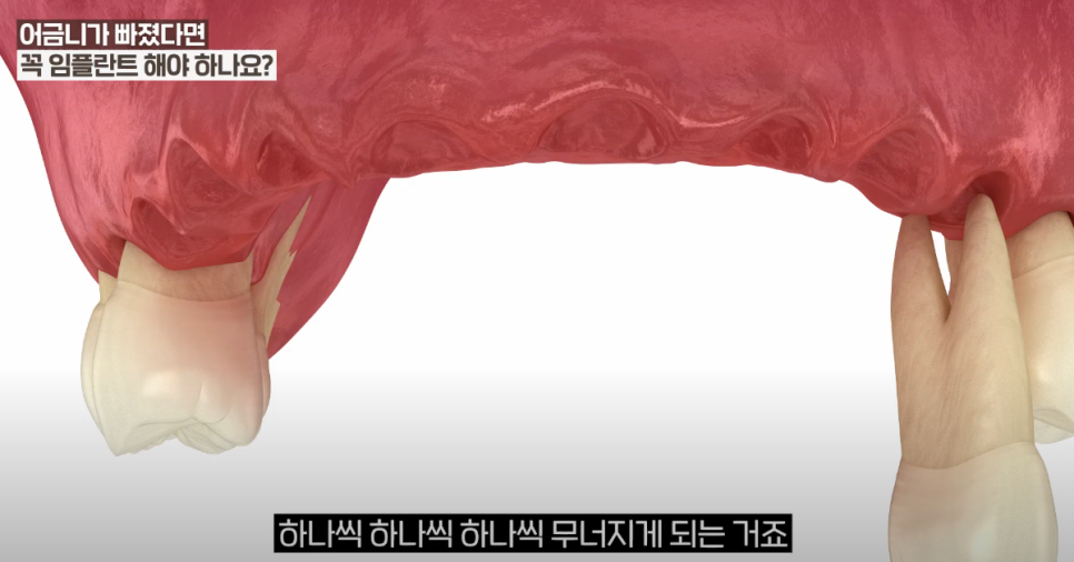 충무로치과 임플란트 어떤 경우에 해야할까? 관련 이미지 2