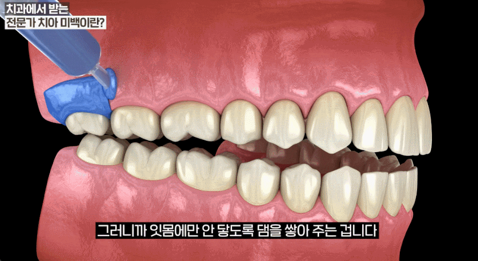 연예인치아미백, 치아 변색 이유부터 알아야 제대로 효과 봅니다 관련 이미지 11