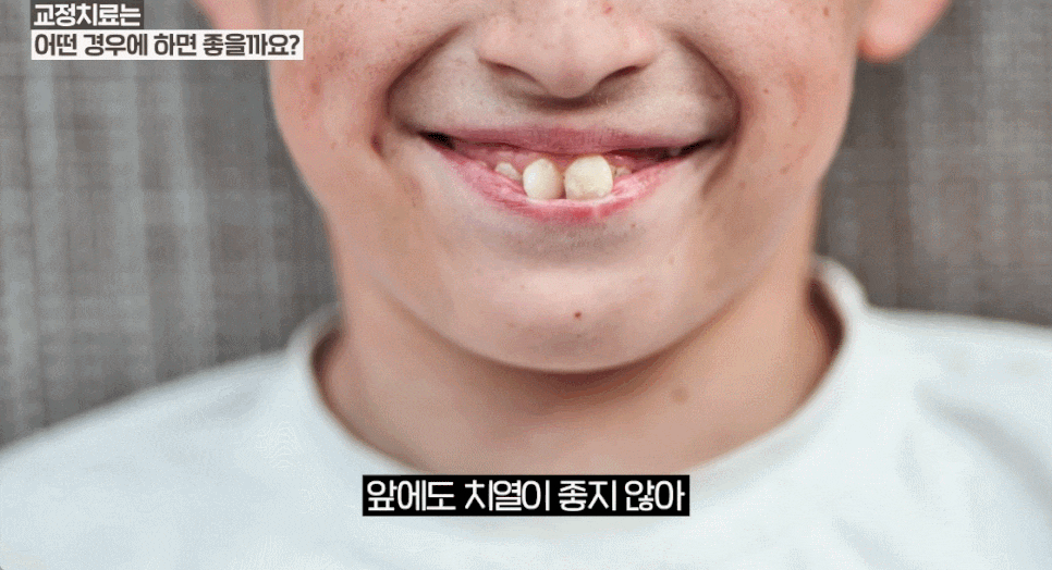 앞니 블랙트라이앵글 치료 : 레진 VS 비니어큐브 VS 교정 가이드 관련 이미지 12
