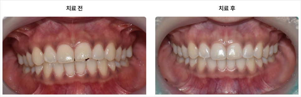 Why 30s Dental Correction Is Necessary and How to Straighten Your Teeth Without Drawing Attention image 11