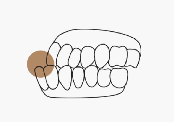 반대교합교정, &lsquo;ㅅㄱ&rsquo;를 놓치면 선택지가 줄어듭니다. 관련 이미지 2